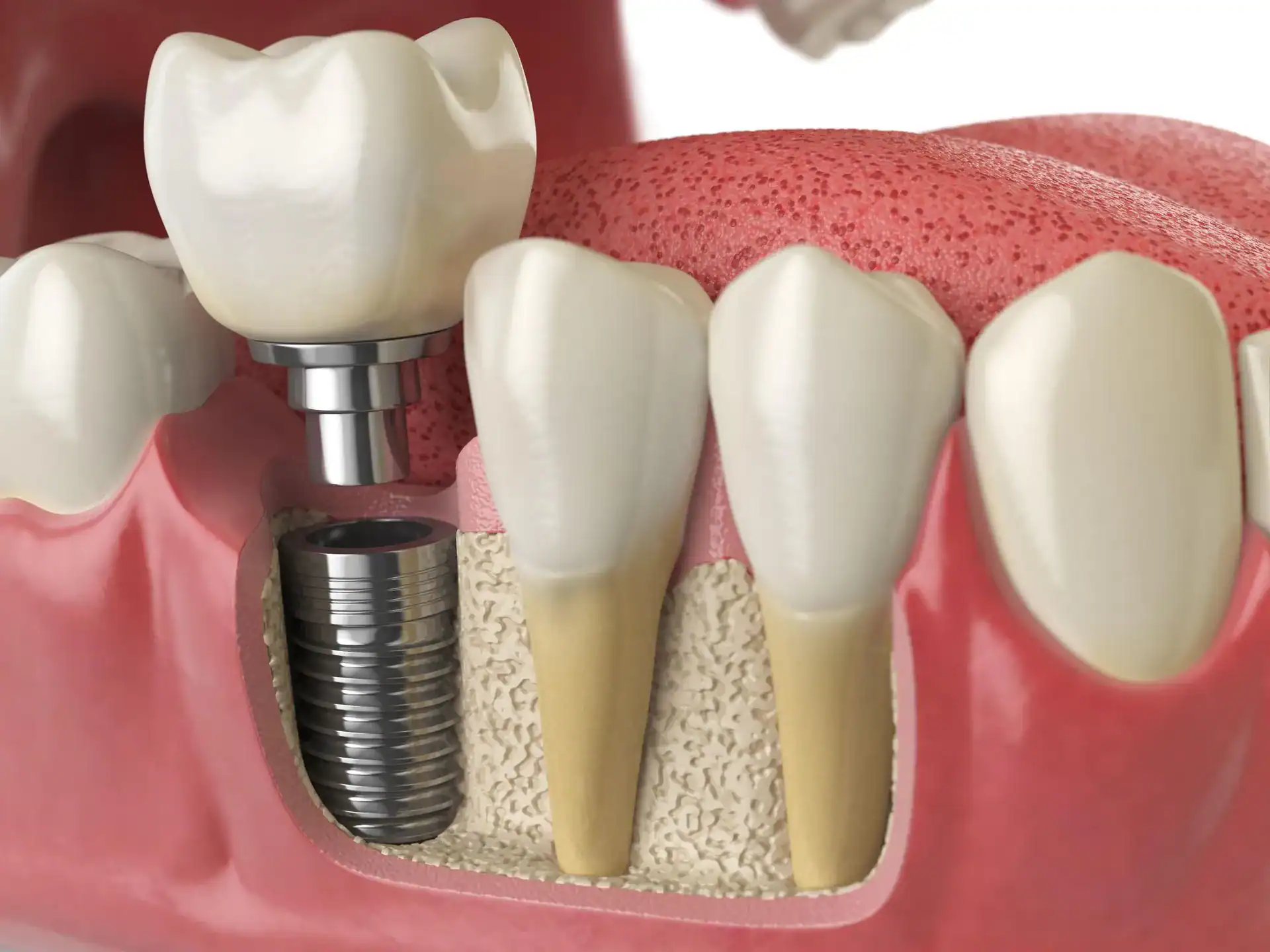 How Do Dental Implants Stay in Place? — Westlake Dental Care, Sterling VA