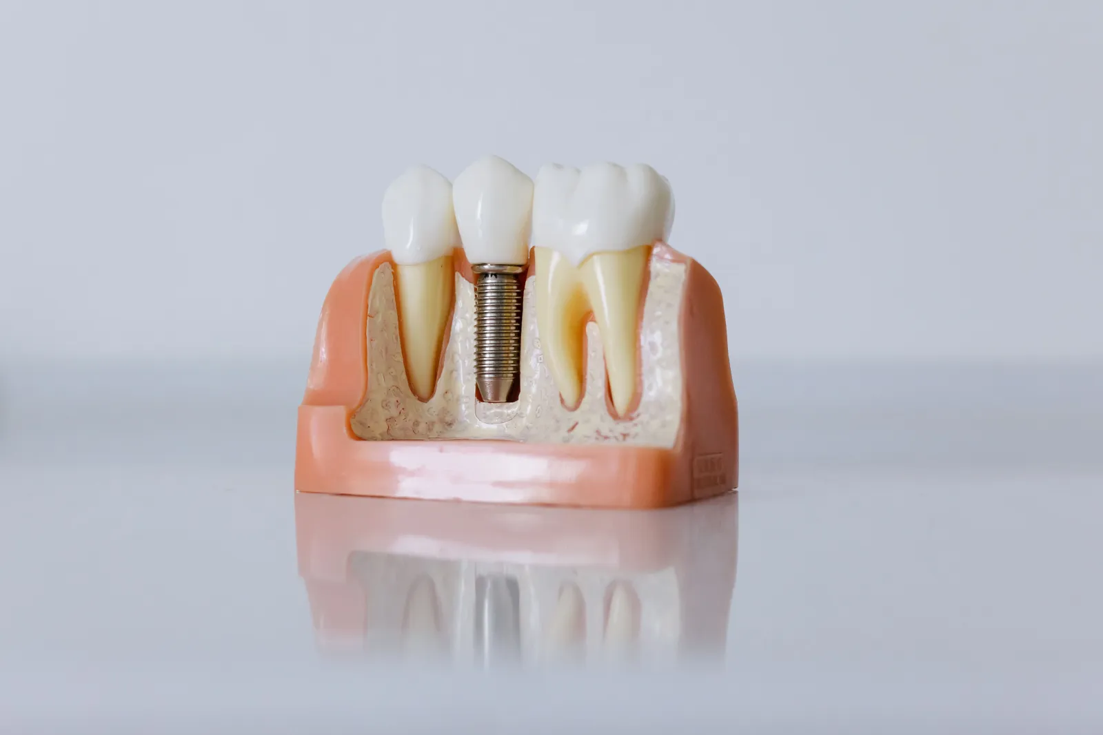 Why Dental Implants Fail, and What Lowers the Risk — Westlake Dental Care, Sterling VA