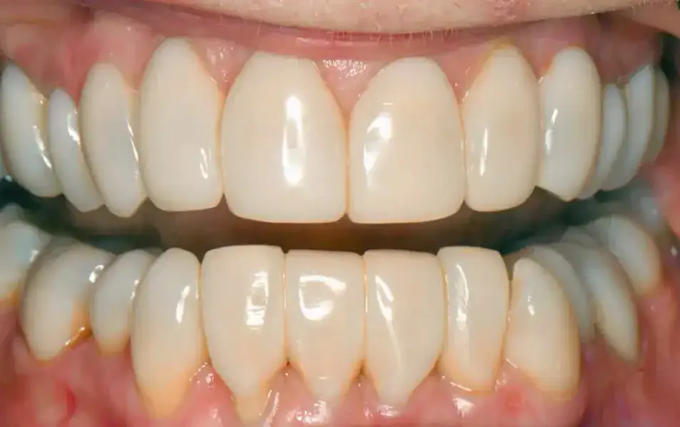 A finished porcelain veneer case at Westlake Dental, upper and lower