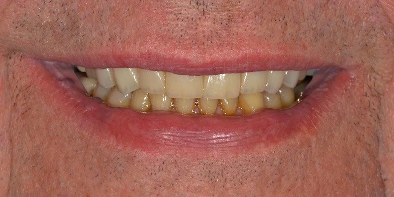 A real Westlake Dental restoration case — after