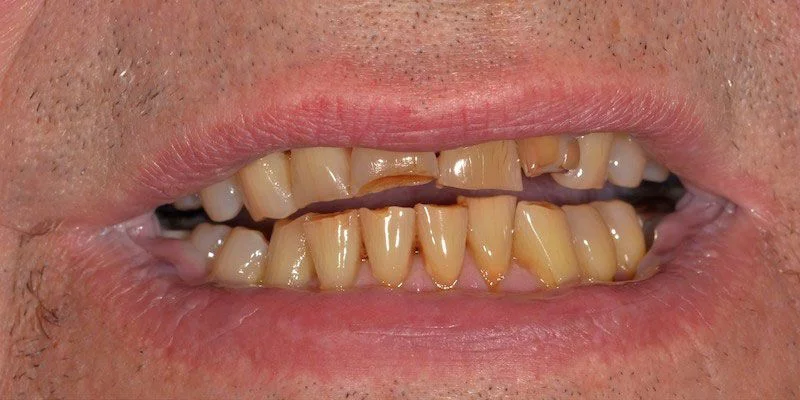 A real Westlake Dental restoration case — before