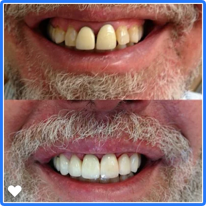 A Westlake Dental veneers case, before and after, side by side