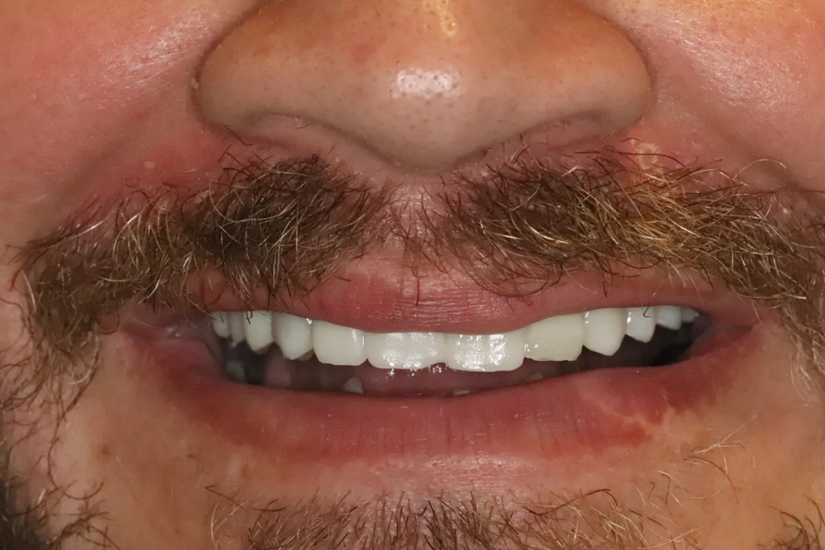 A close view of the mock-up worn over the guest's own teeth