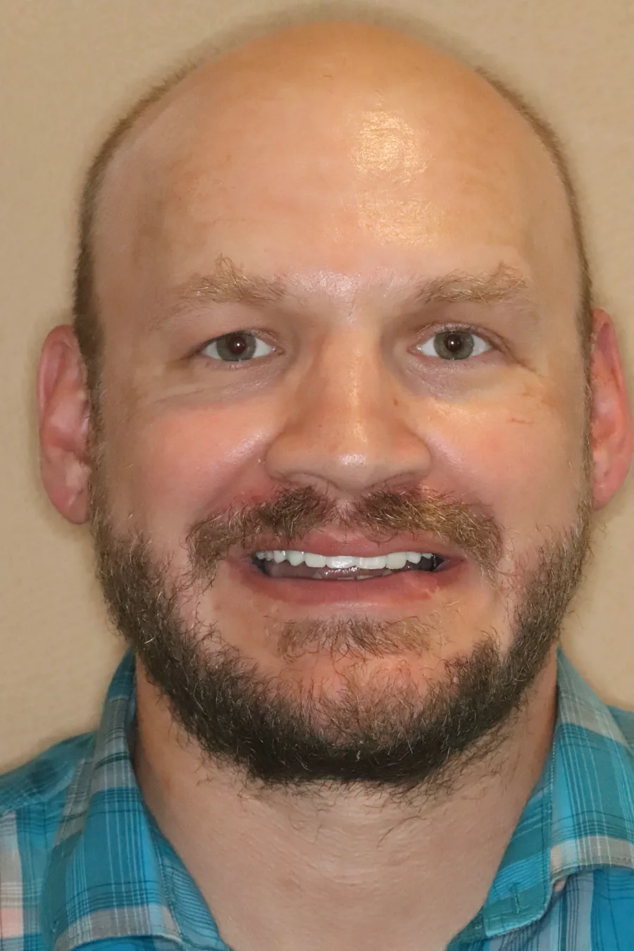 The same guest, the same visit, wearing the mock-up of his planned smile
