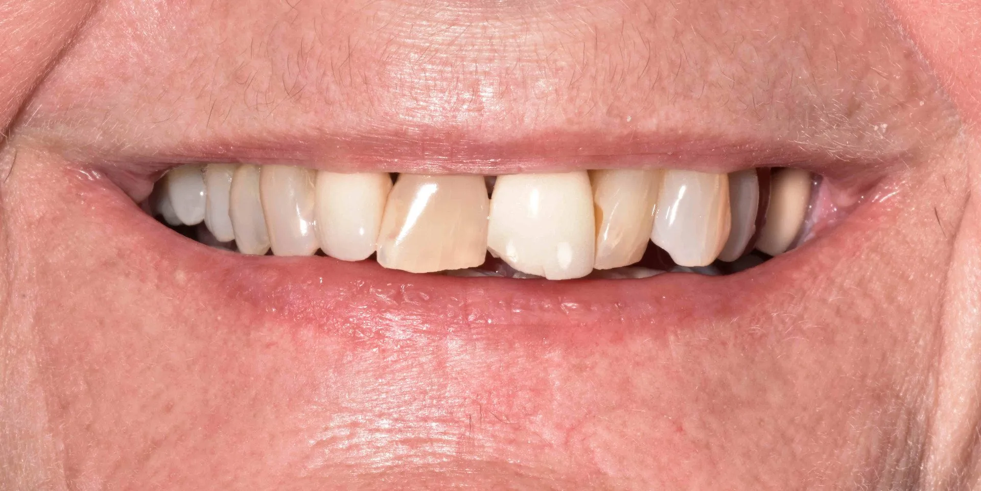 Close-up–pre-op-smile-min-1920w Close-up--pre-op-smile-min-1920w