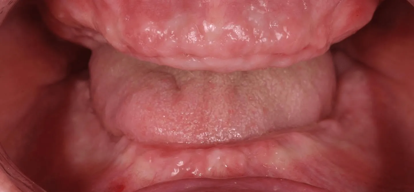 pre-post-dentures-1-min-1920w pre-post-dentures-1-min-1920w