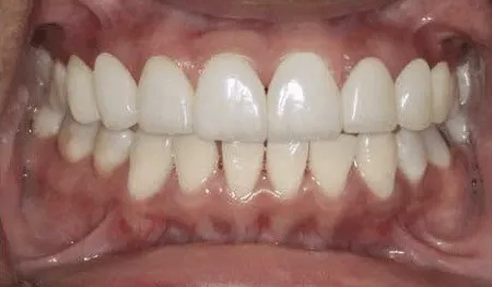 pre-post-veneers-485523d1-min-1920w pre-post-veneers-485523d1-min-1920w