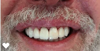 pre-post-veneers-56180bdd-min-1920w pre-post-veneers-56180bdd-min-1920w