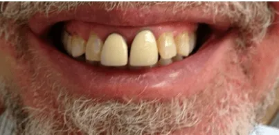 pre-post-veneers-min-1920w pre-post-veneers-min-1920w