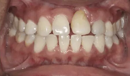 pre-post-veneers+(1)-min-1920w pre-post-veneers+(1)-min-1920w