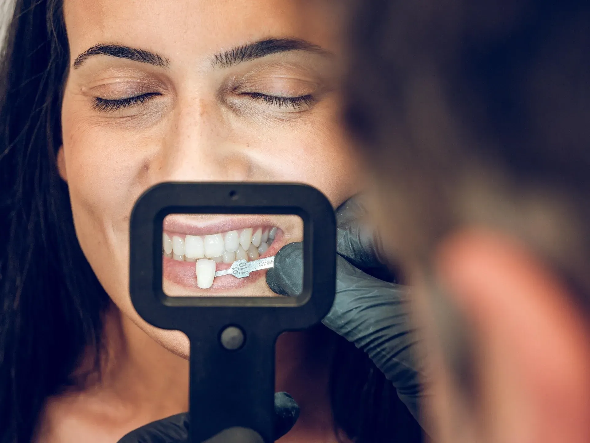 Do Veneers Fall Out? Testing Common Veneer Myths